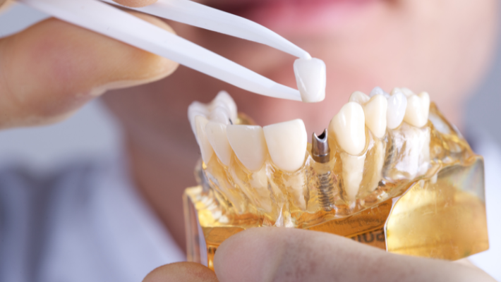 Les dernières avancées en matière d’implants dentaires au cabinet Esthetique dentaire Marrakech