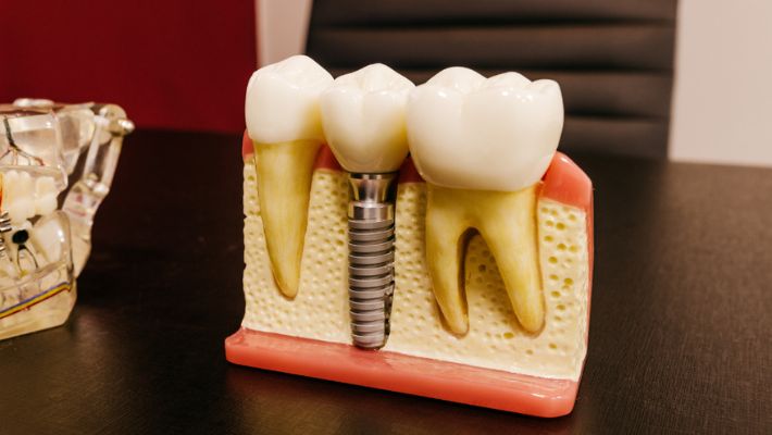 Decoding Myths and Truths About Dental Implants