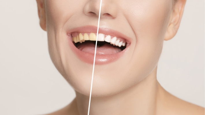 The Psychological Benefits of Teeth Whitening  