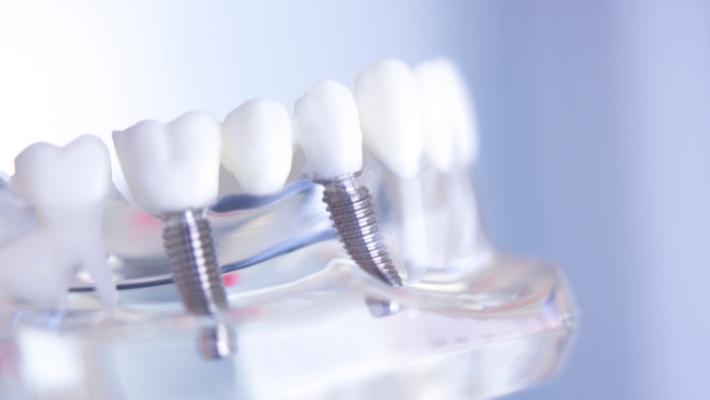 Les critères de qualité pour les matériaux d'implants dentaires à Marrakech  