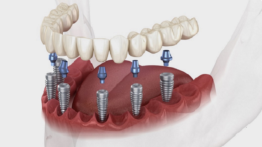 Prix des implants dentaires à Marrakech